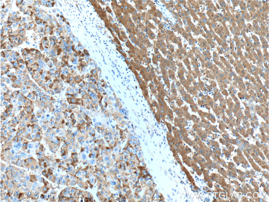 16591-1-AP;human liver cancer tissue