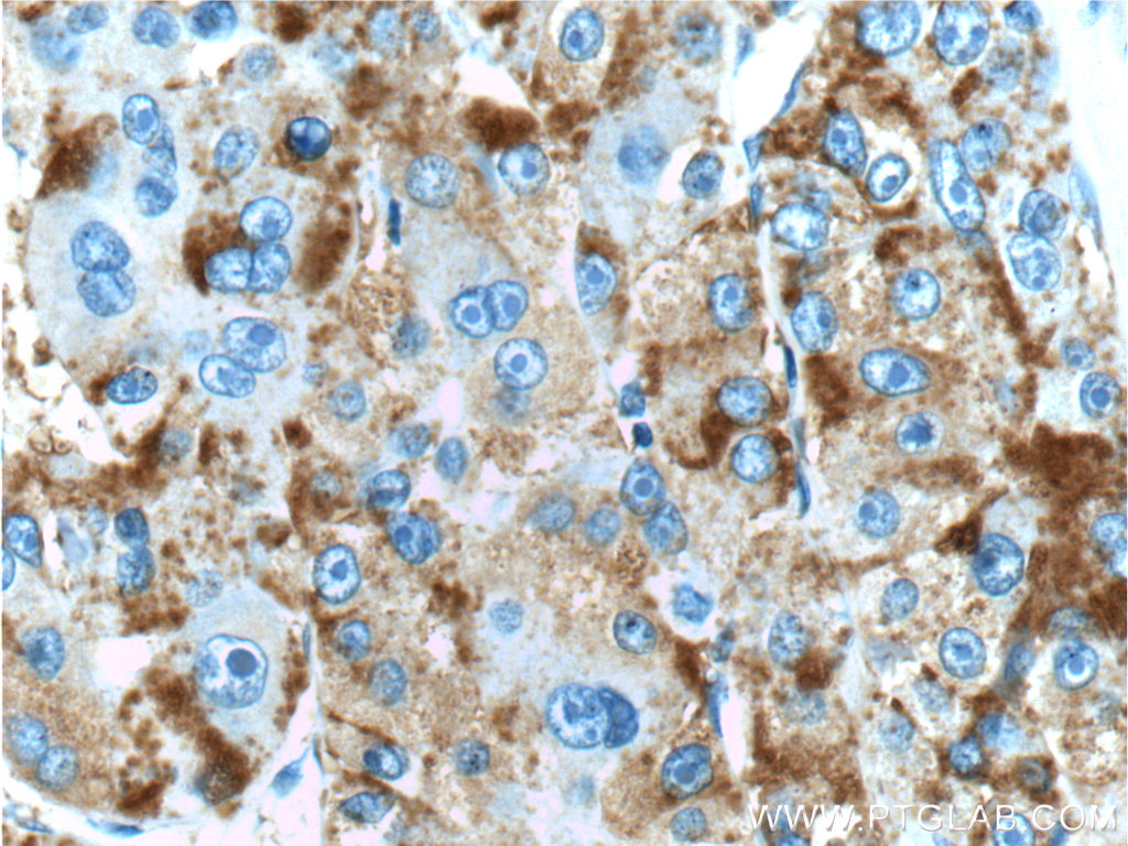 16591-1-AP;human liver cancer tissue