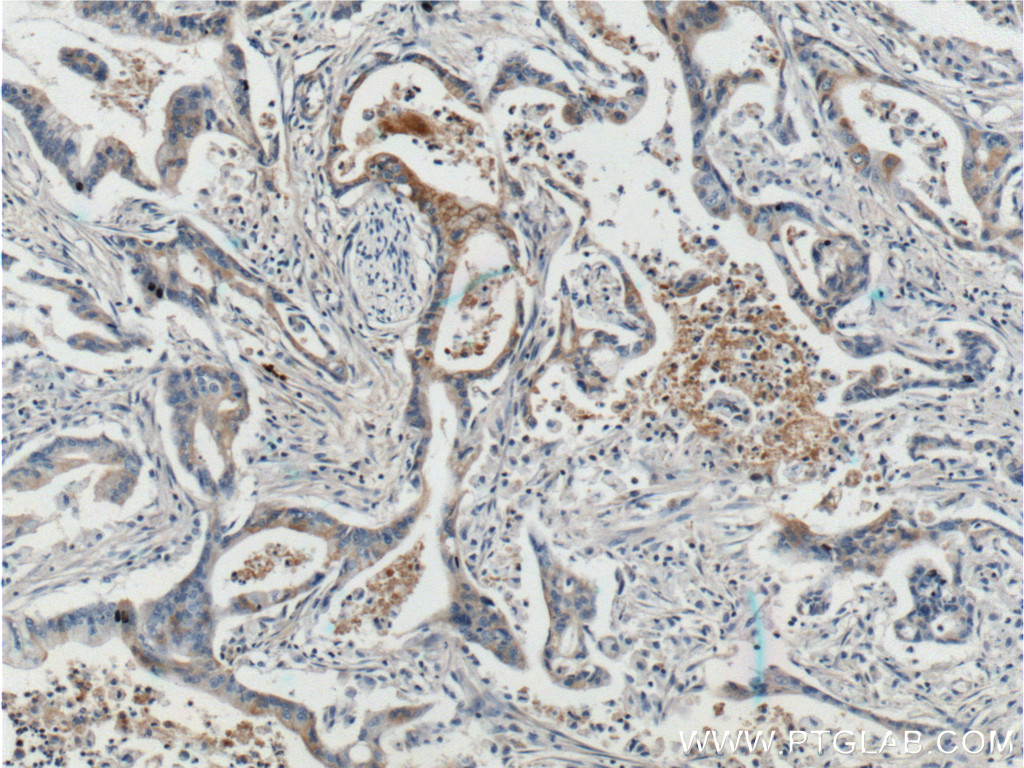 20259-1-AP;human pancreas cancer tissue