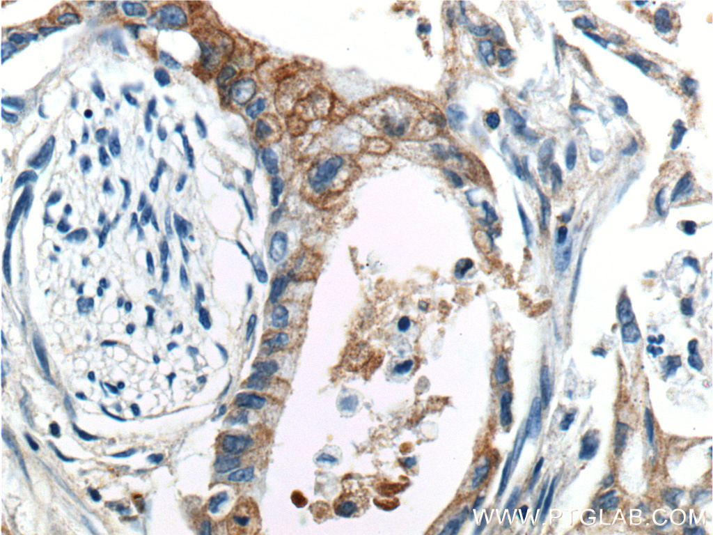 20259-1-AP;human pancreas cancer tissue