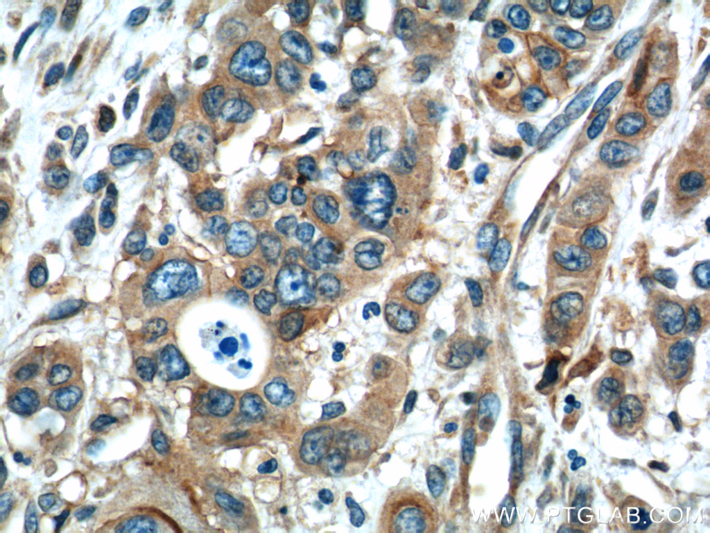 24934-1-AP;human stomach cancer tissue