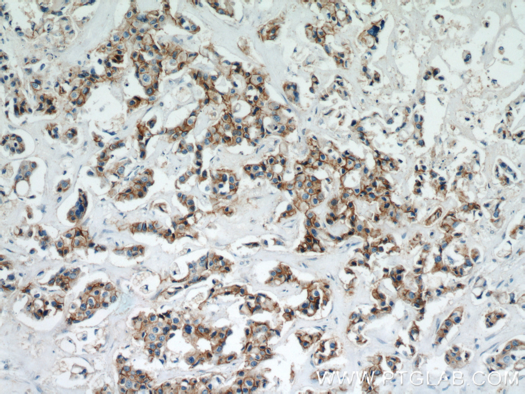 21972-1-AP;human breast cancer tissue