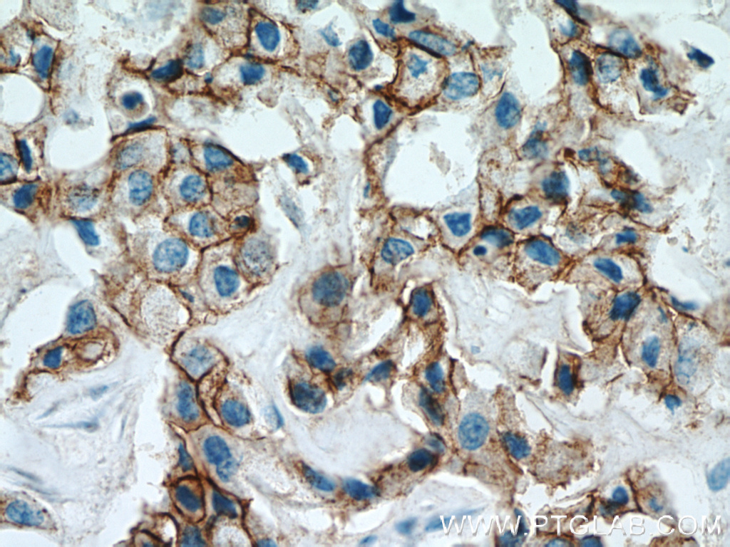 21972-1-AP;human breast cancer tissue