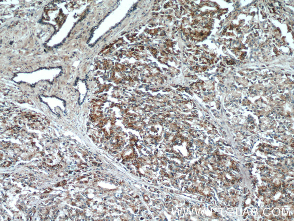 23838-1-AP;human prostate cancer tissue