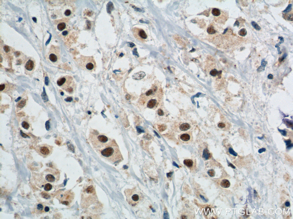 14559-1-AP;human breast cancer tissue