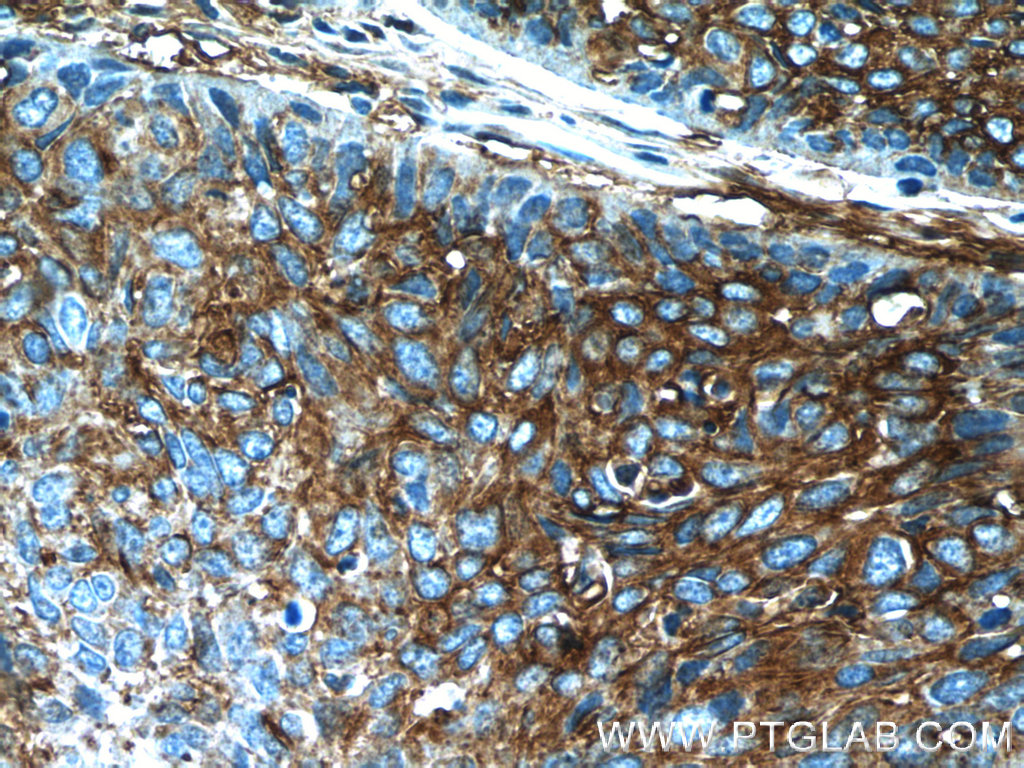 25925-1-AP;human lung cancer tissue