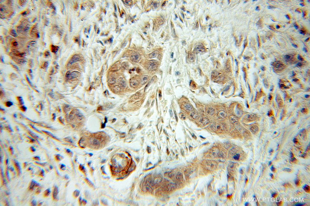 11169-1-AP;human pancreas cancer tissue