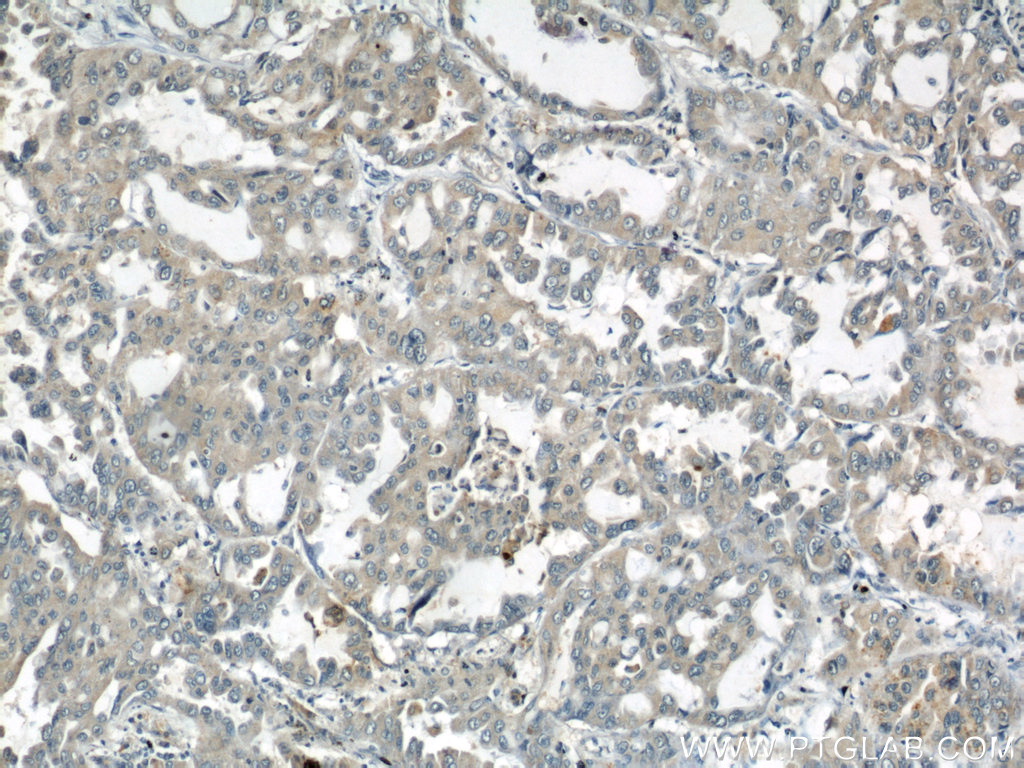 10930-1-AP;human lung cancer tissue