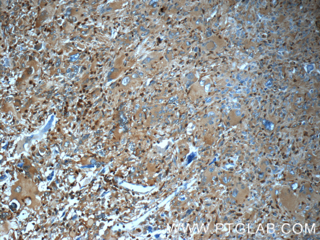 16717-1-AP;human gliomas tissue