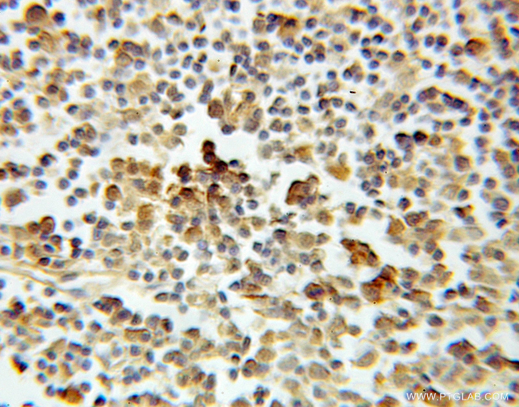 10784-1-AP;Lymphoma