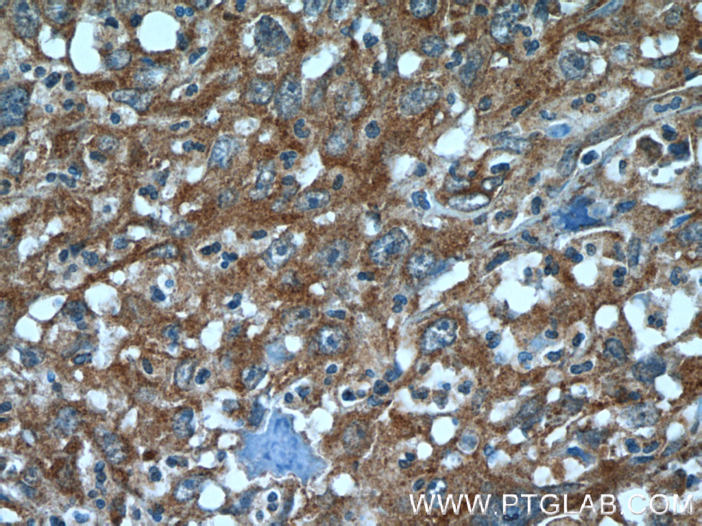 24169-1-AP;human cervical cancer tissue