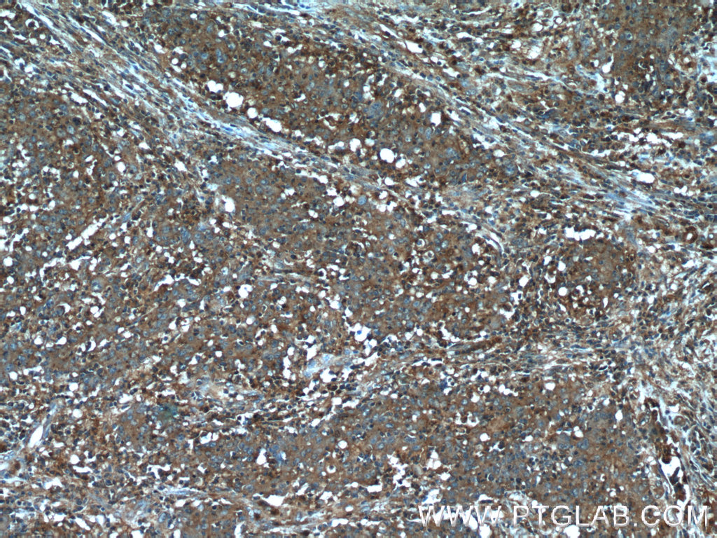 24024-1-AP;human colon cancer tissue