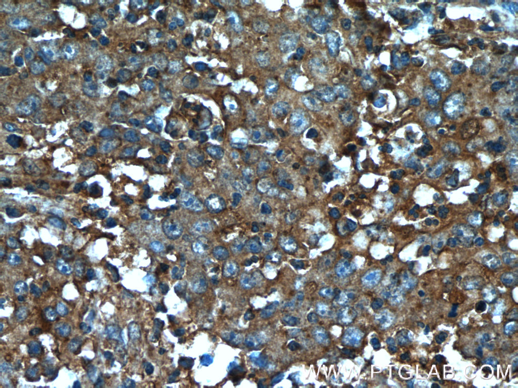 24024-1-AP;human colon cancer tissue