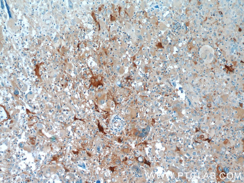 10599-1-AP;human gliomas tissue