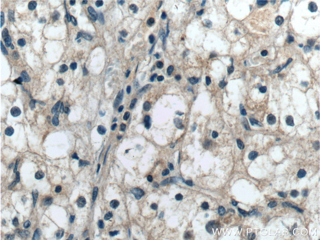 13685-1-AP;human renal cell carcinoma tissue