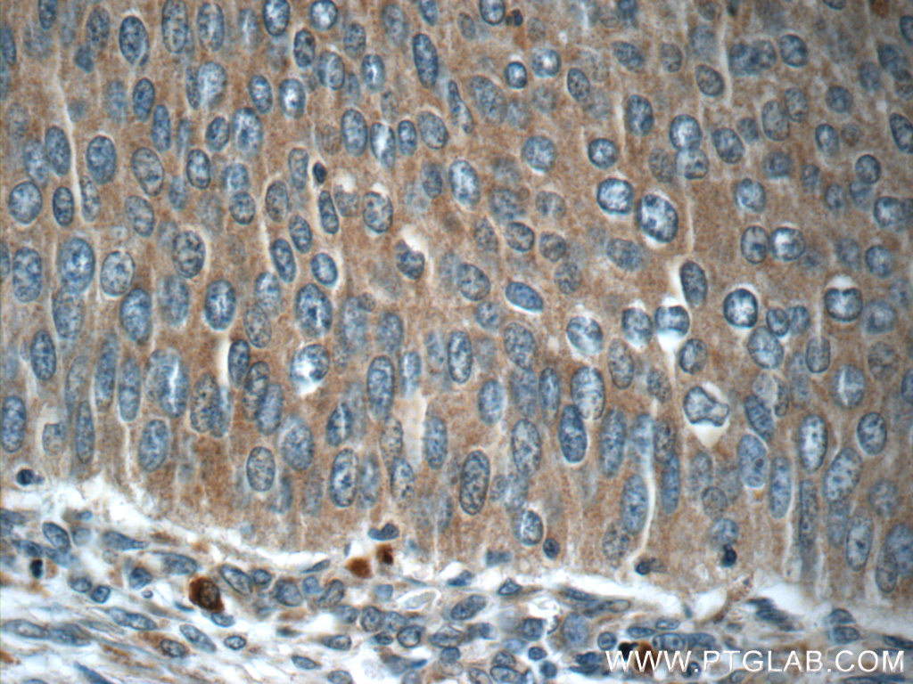 24865-1-AP;human cervical cancer tissue