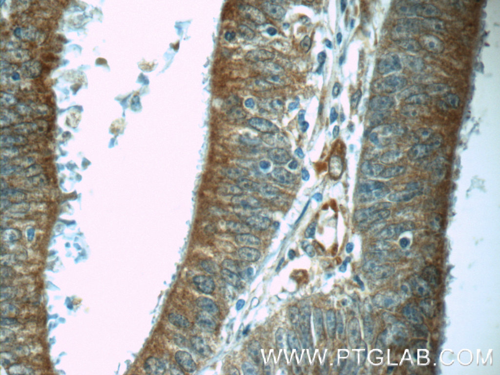 24690-1-AP;human colon cancer tissue