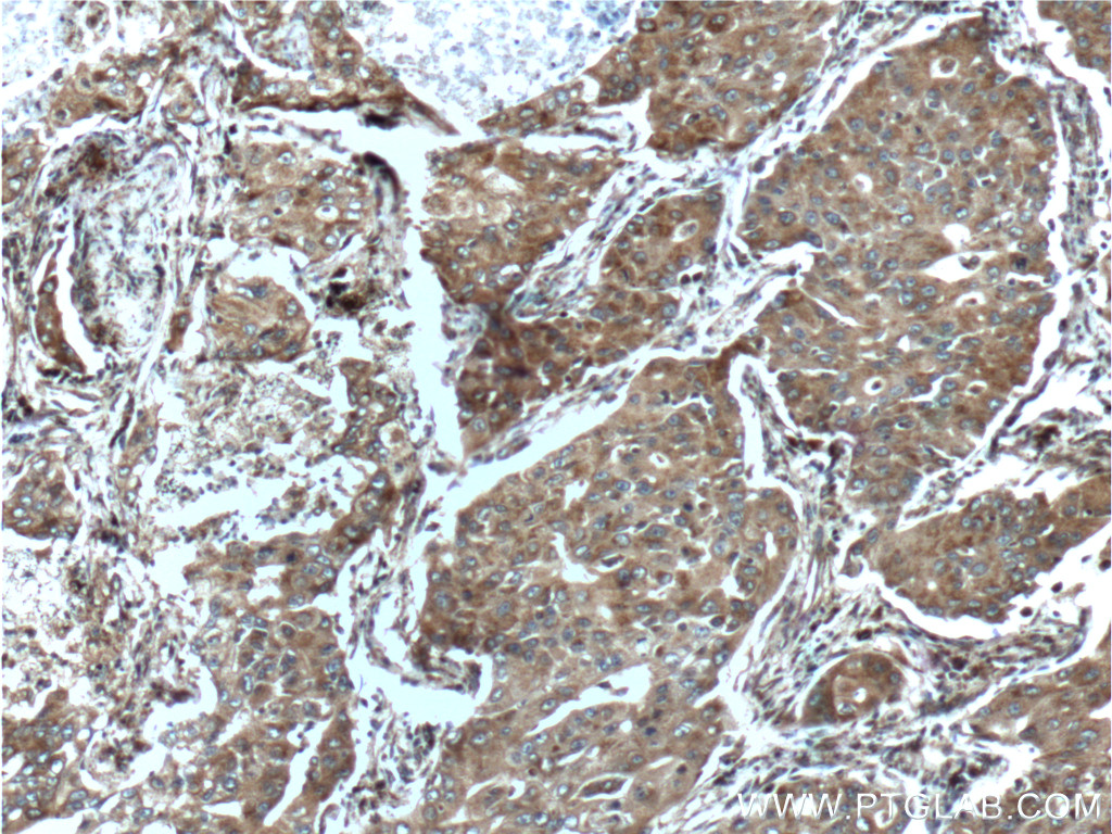 12363-1-AP;human lung cancer tissue