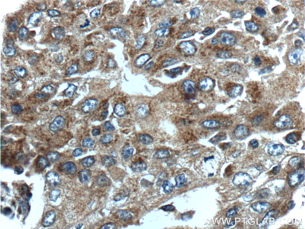 12363-1-AP;human lung cancer tissue