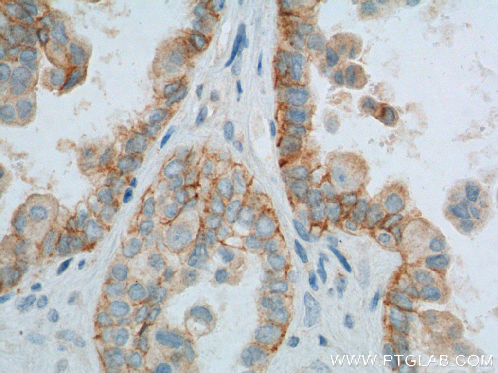 20305-1-AP;human ovary tumor tissue