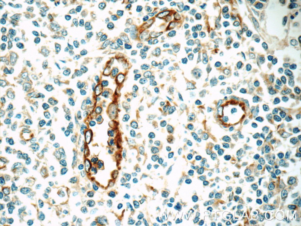 22003-1-AP;human tonsillitis tissue