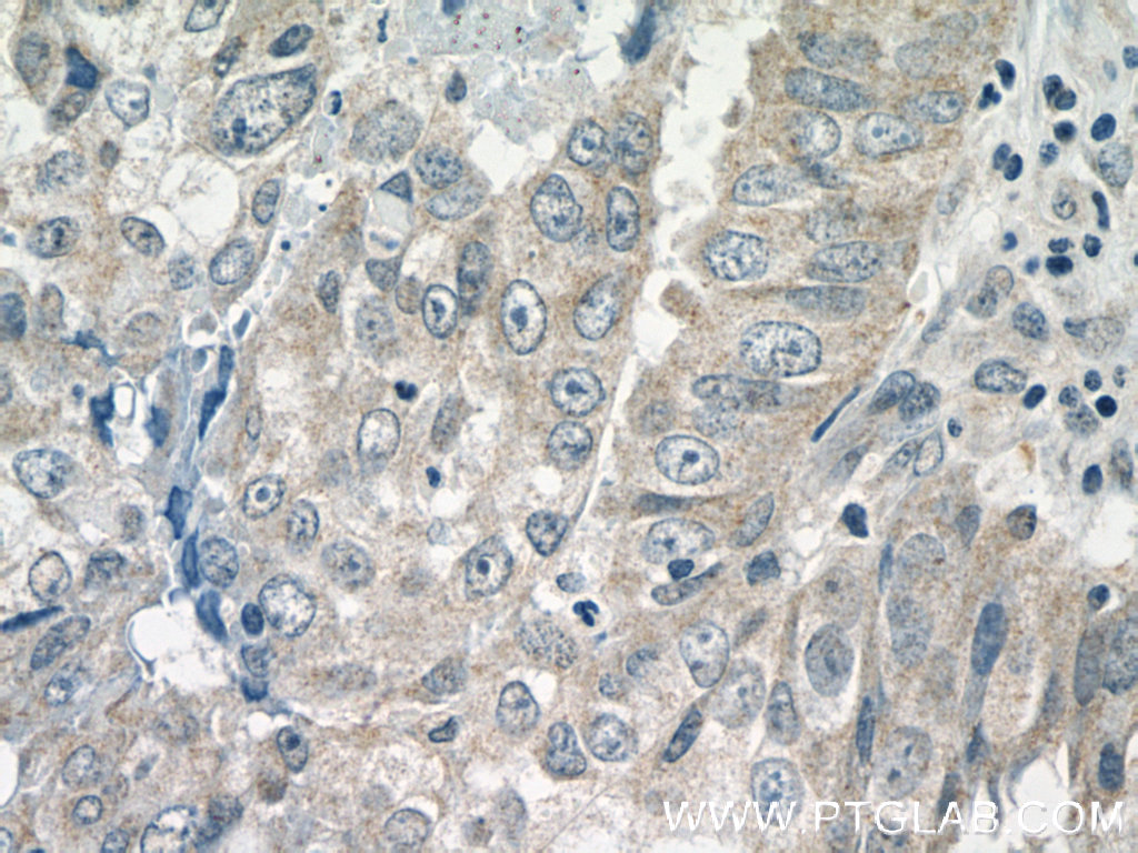 13274-1-AP;human breast cancer tissue