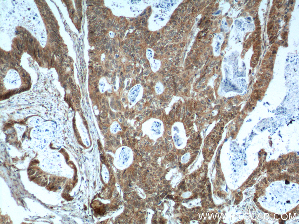 12180-1-AP;human colon cancer tissue