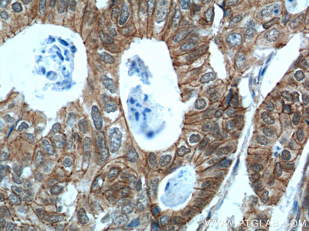 12180-1-AP;human colon cancer tissue