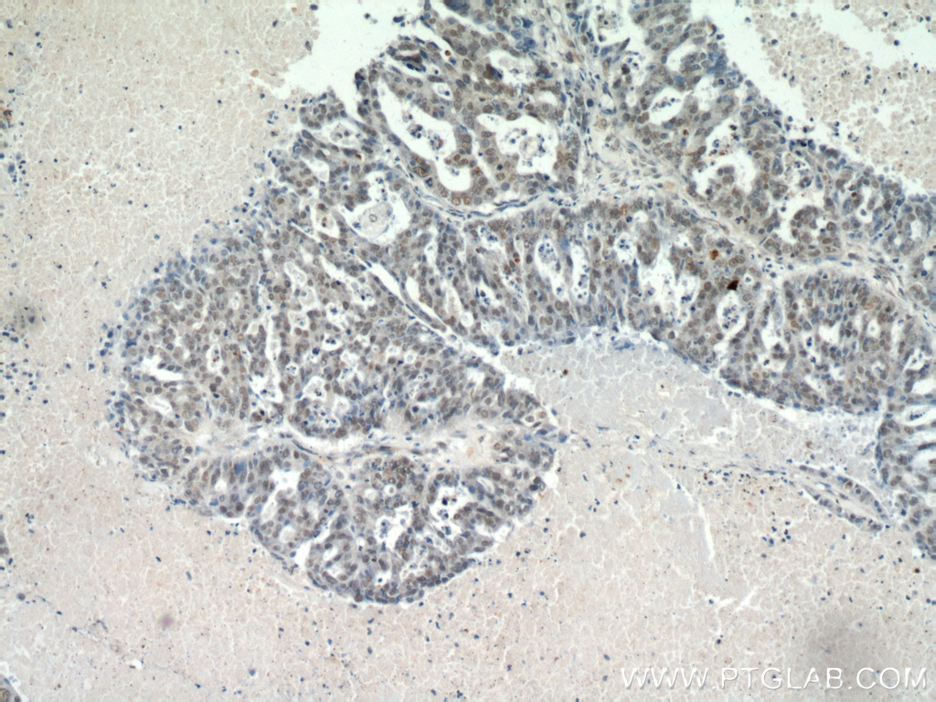 20672-1-AP;human ovary tumor