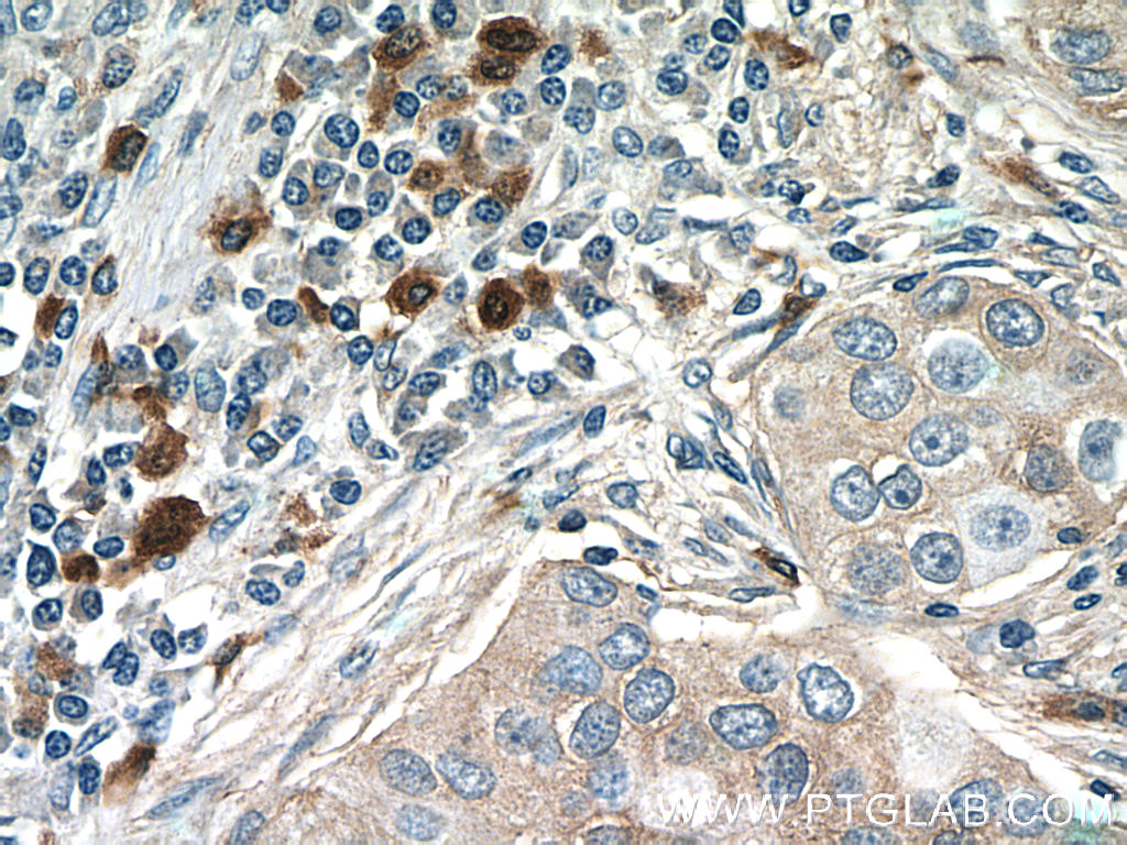 18108-1-AP;human breast cancer tissue