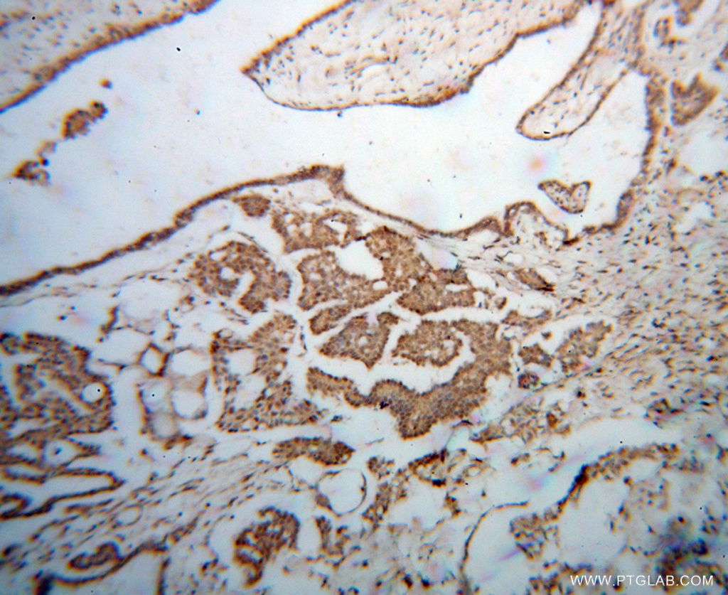 14689-1-AP;human ovary tumor