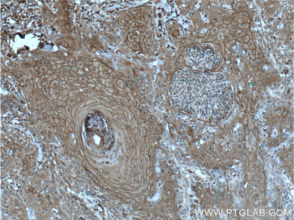 24587-1-AP;human skin cancer tissue