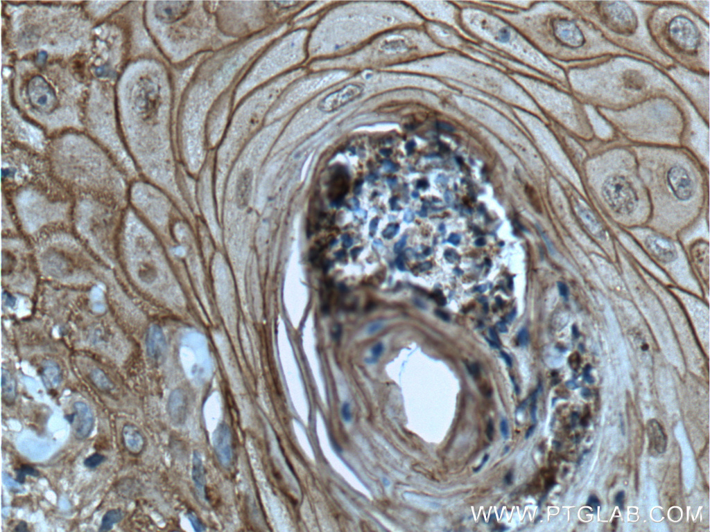 24587-1-AP;human skin cancer tissue