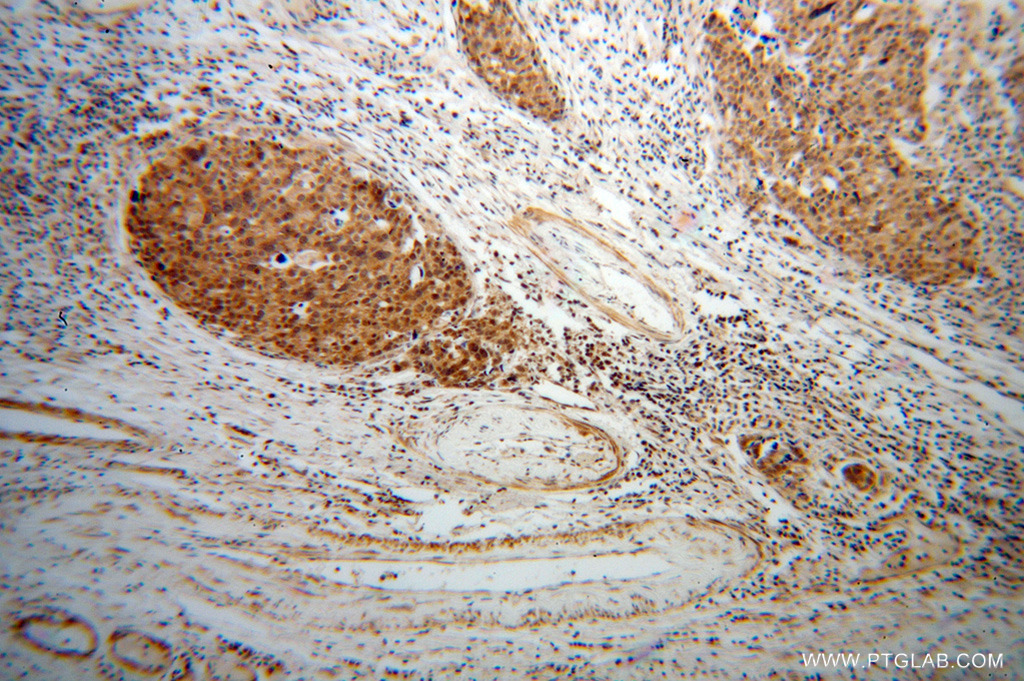 11280-1-AP;human ovary tumor