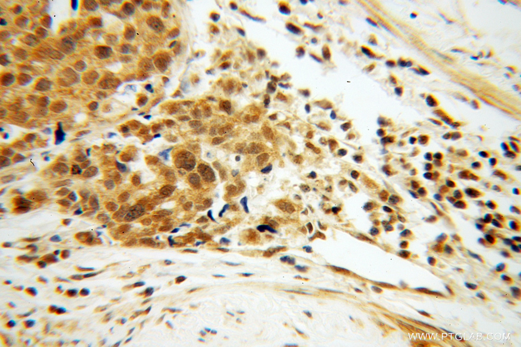 11280-1-AP;human ovary tumor