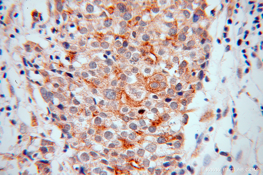 10423-1-AP;human ovary tumor