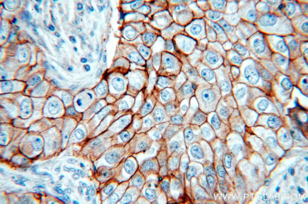 51105-1-AP;human breast cancer tissue