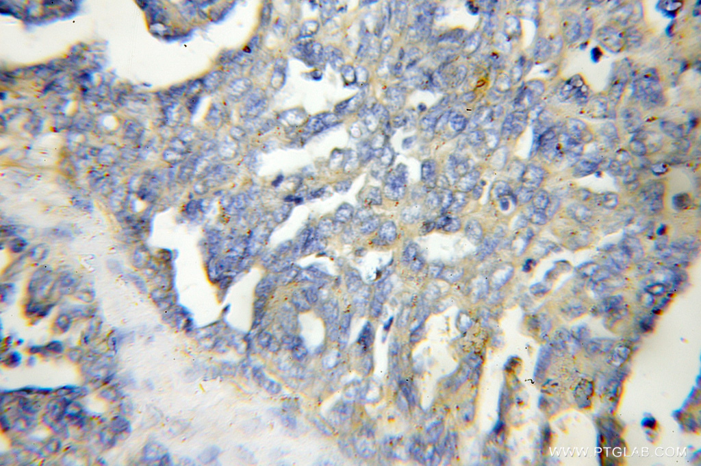 11453-1-AP;human ovary tumor