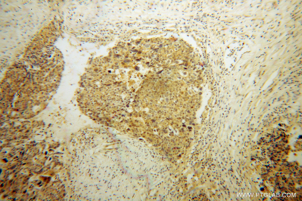 11028-2-AP;human ovary tumor