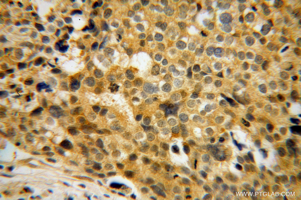 11028-2-AP;human ovary tumor