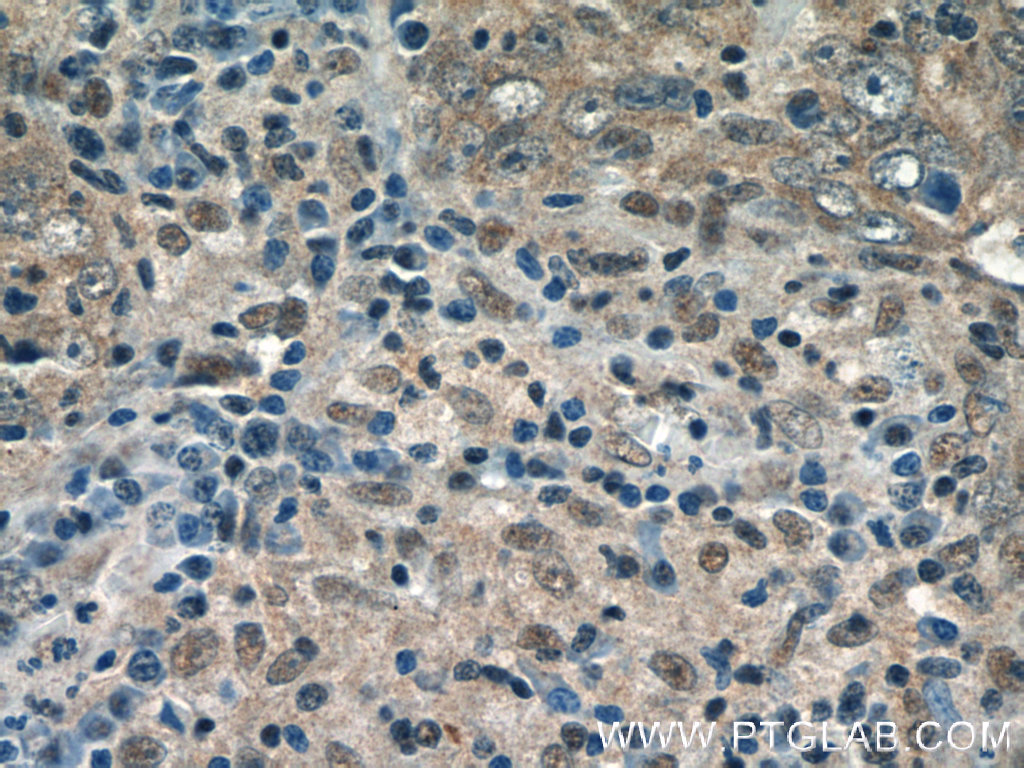 24366-1-AP;human breast cancer tissue