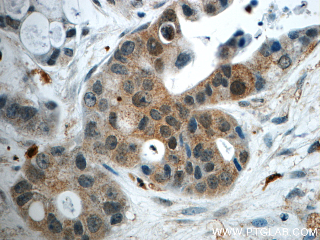 24399-1-AP;human liver cancer tissue