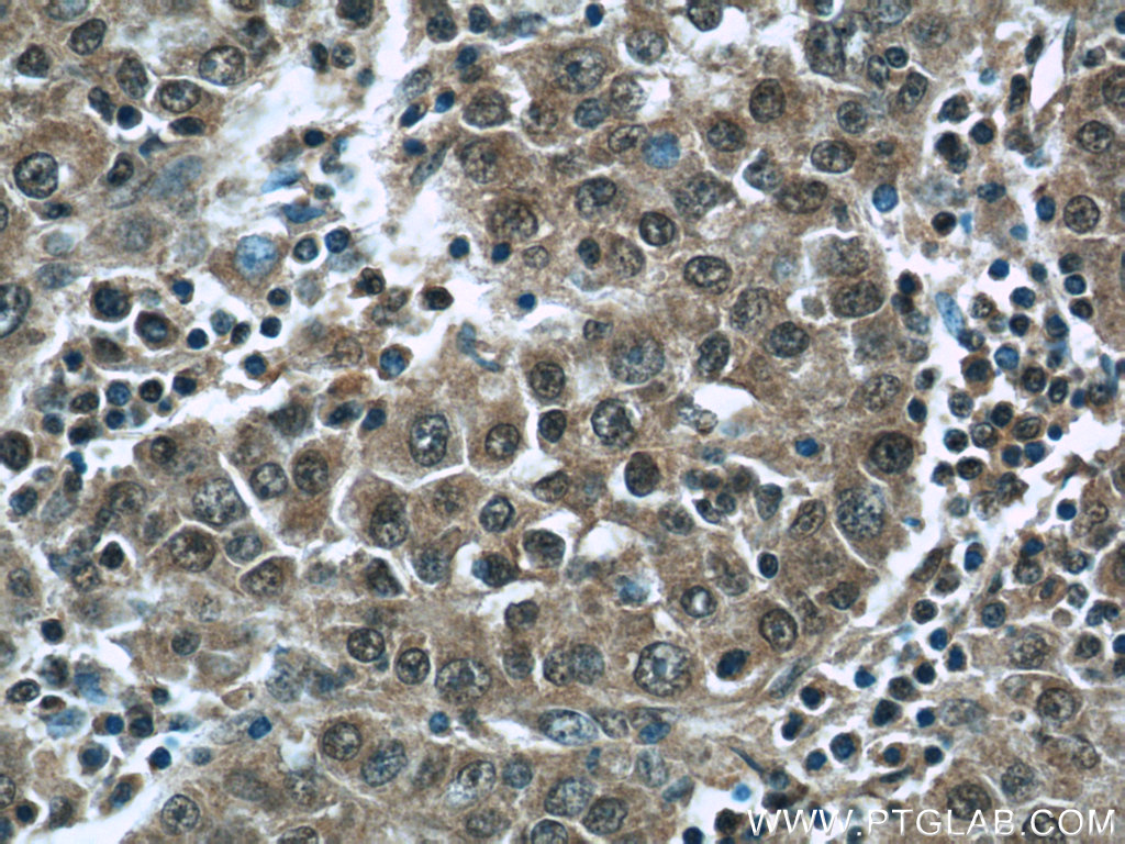 24913-1-AP;human liver cancer tissue