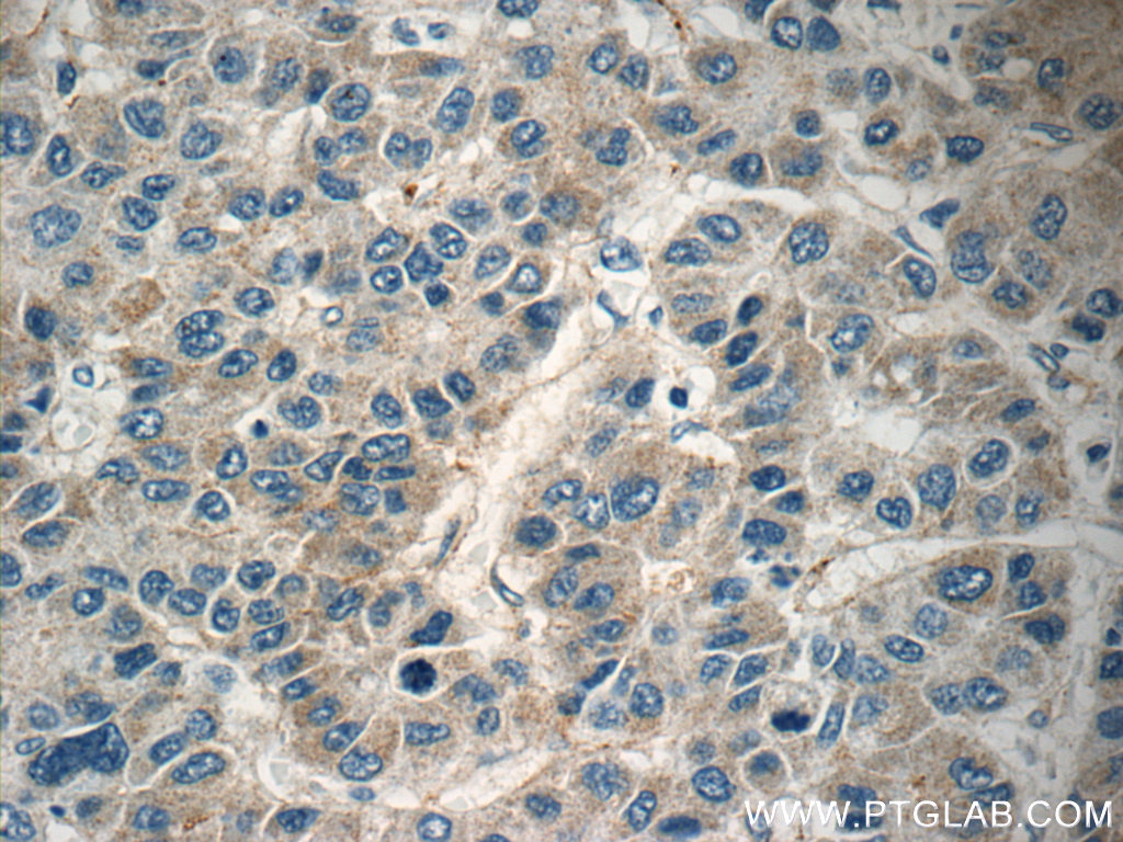 16842-1-AP;human liver cancer tissue