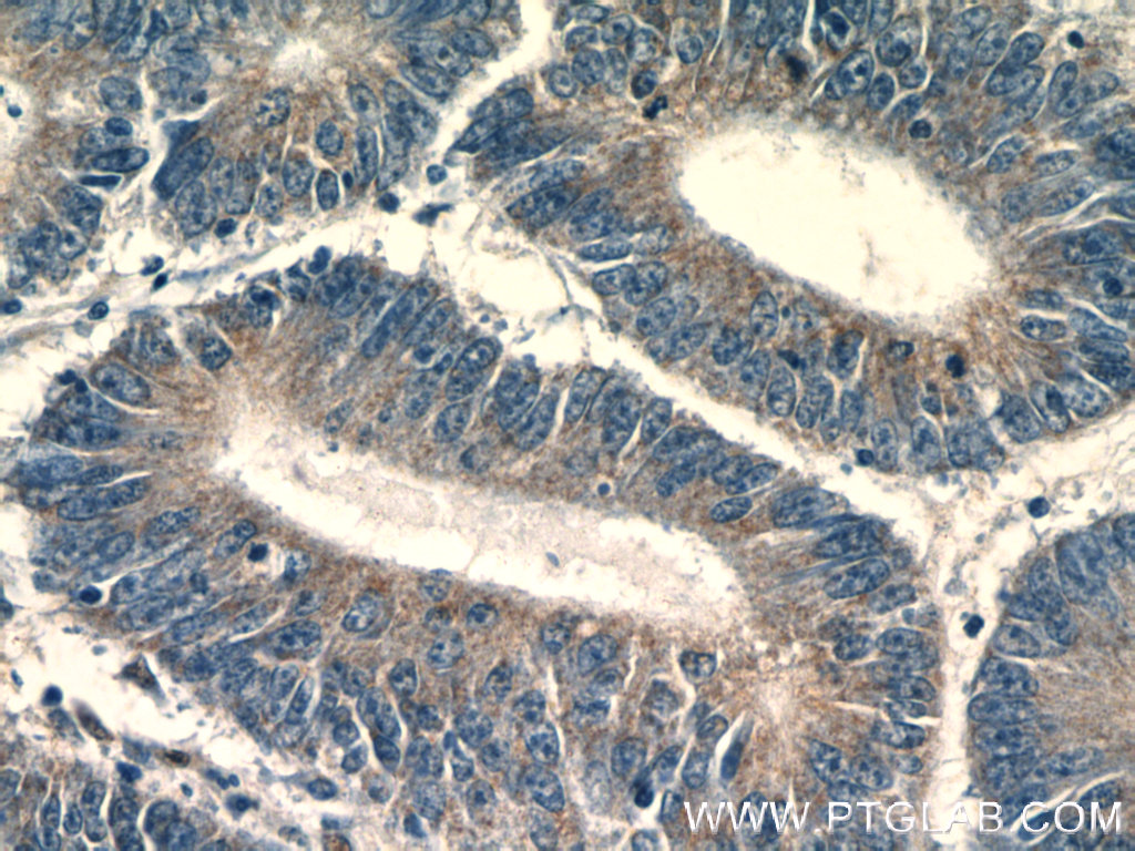 18354-1-AP;human colon cancer tissue