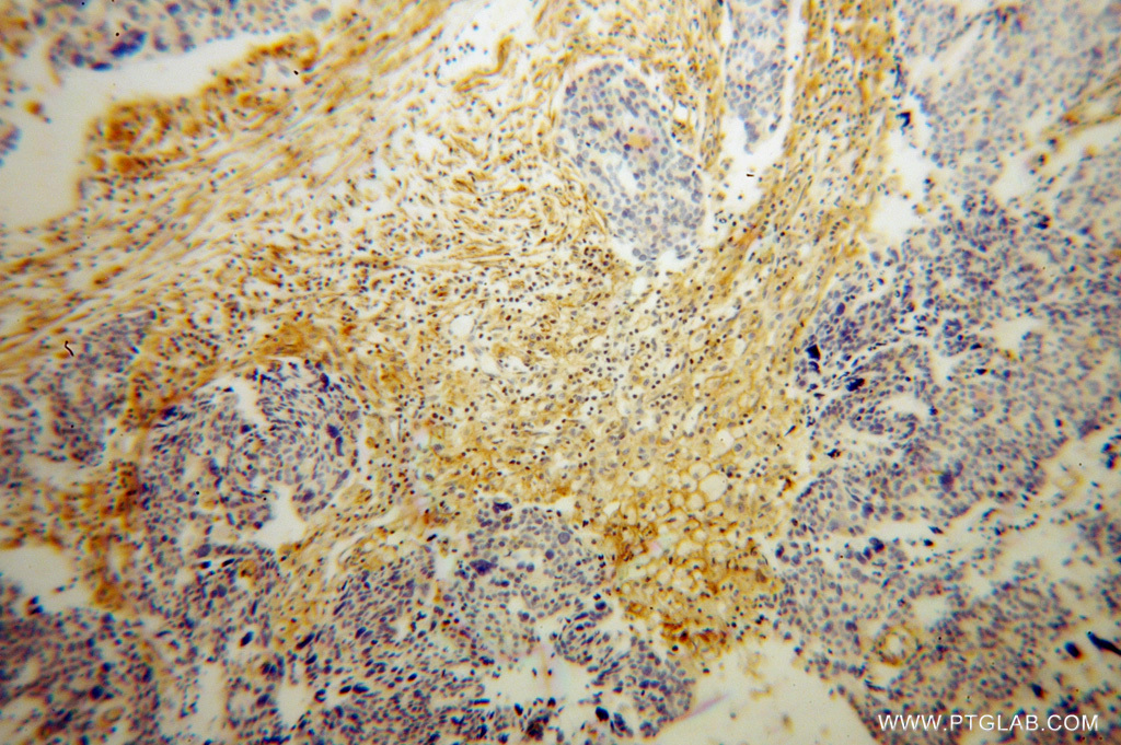 10978-1-AP;Ovary tumor