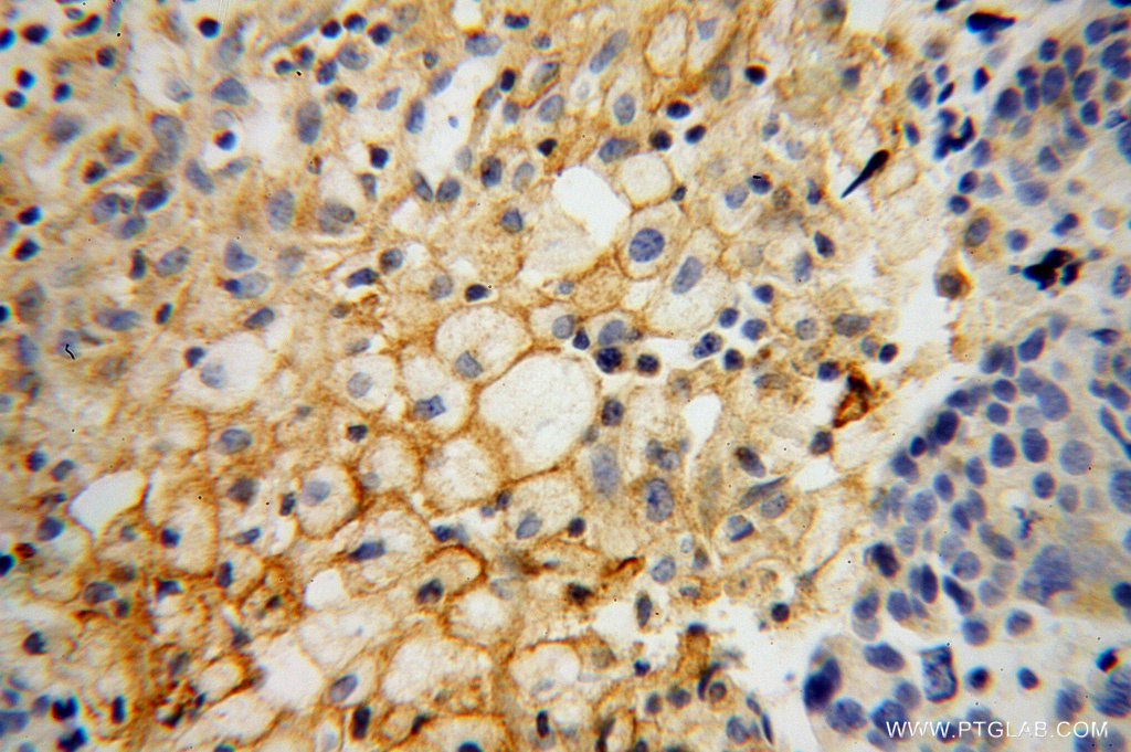 10978-1-AP;Ovary tumor