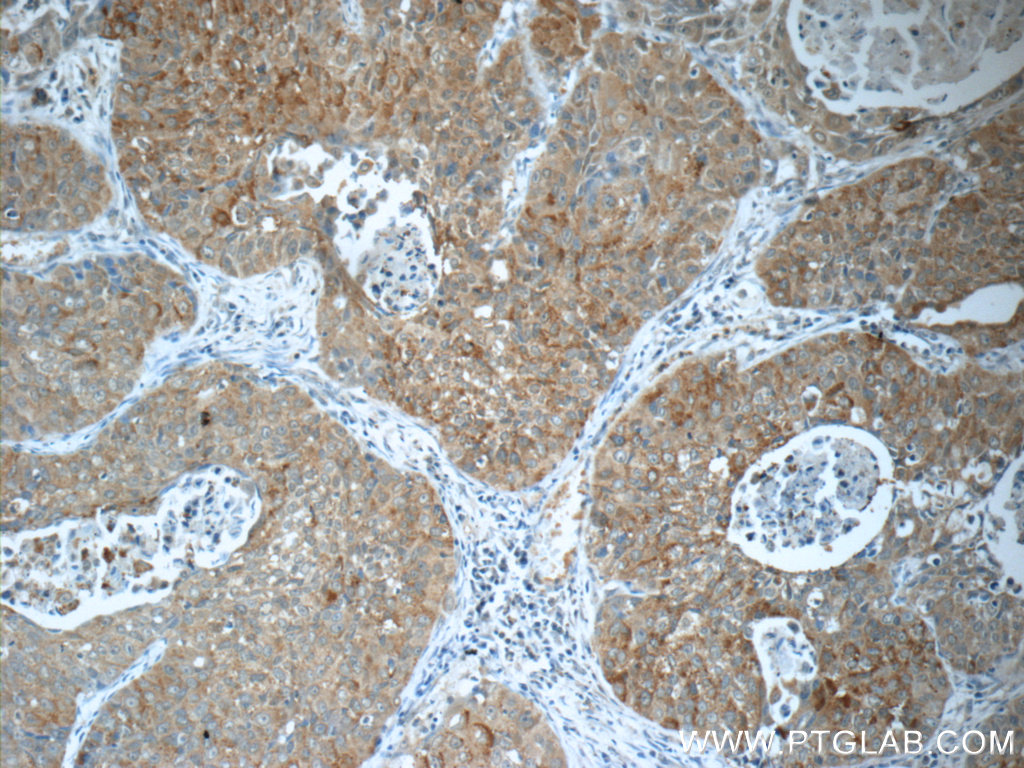 18847-1-AP;human lung cancer tissue