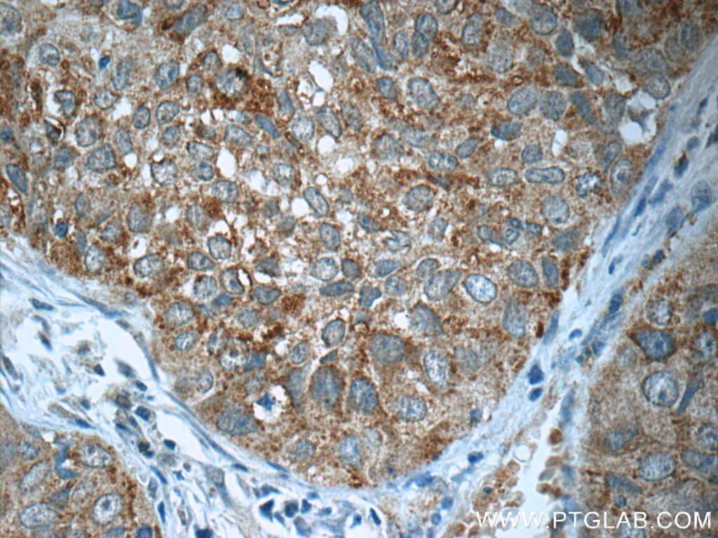 18847-1-AP;human lung cancer tissue