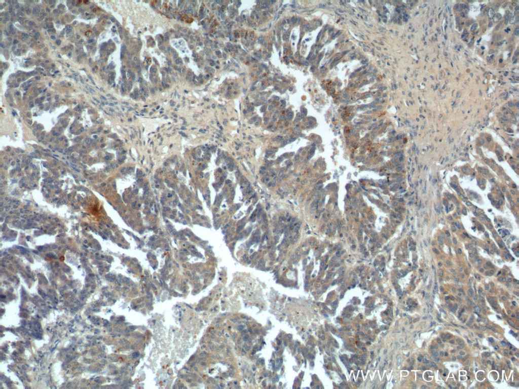 14232-1-AP;human ovary tumor tissue